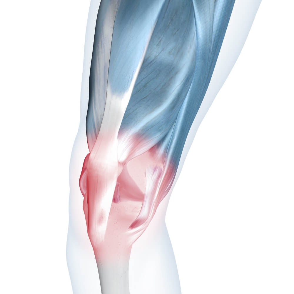 Sore Knee Illustration