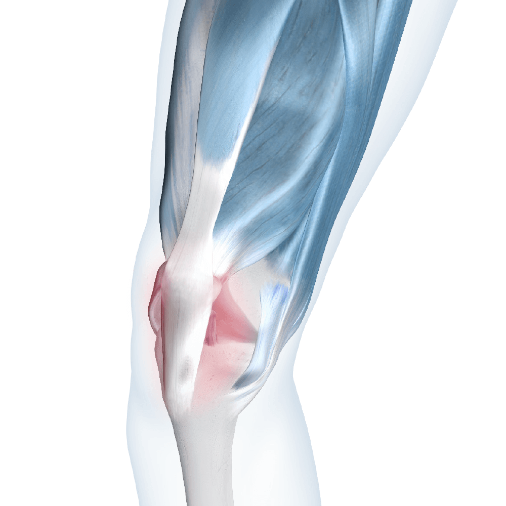 Runners Knee Image