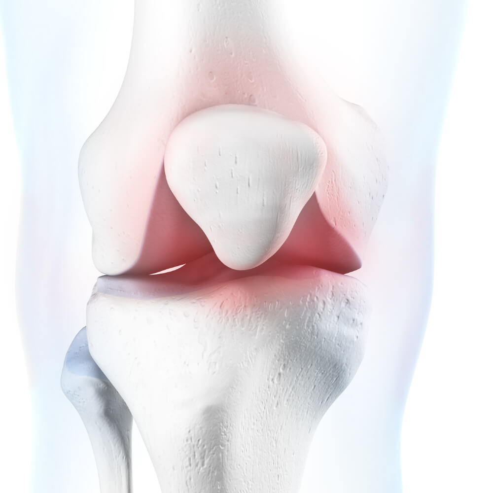 Runners Knee Illustration