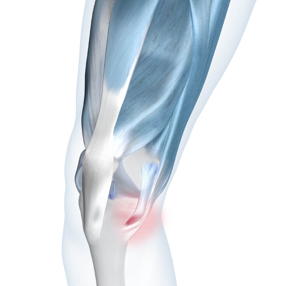 Pes Anserine Bursitis Illustration