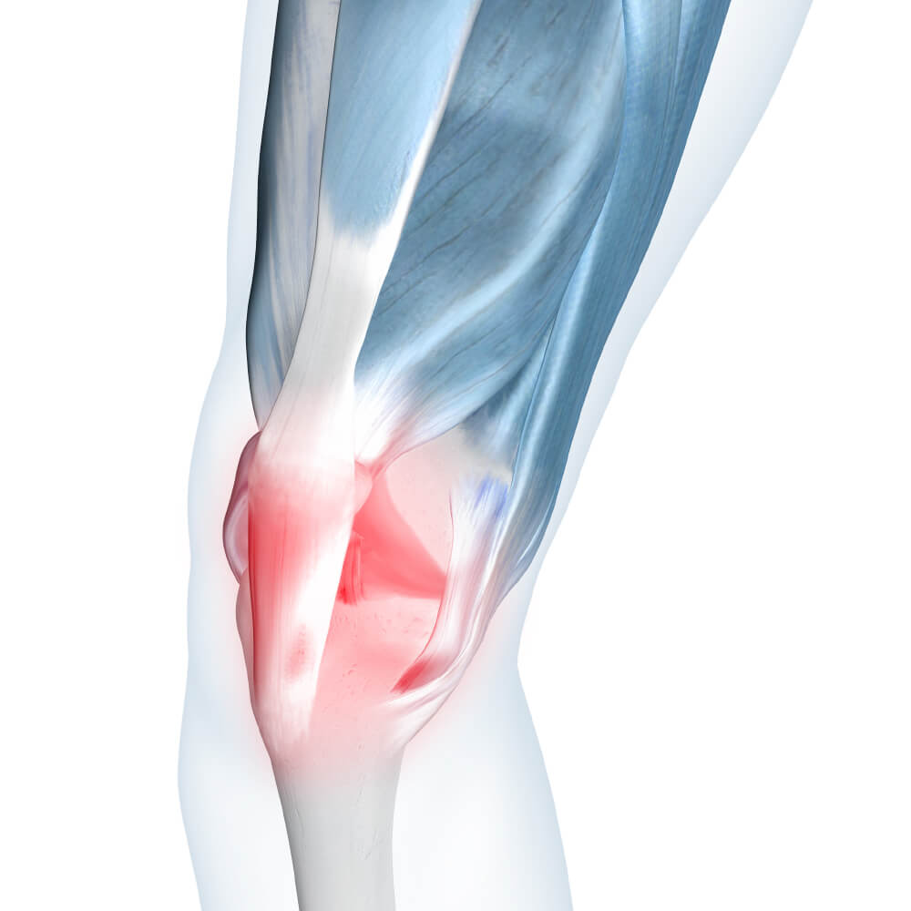 Patellar Tendonitis Illustration