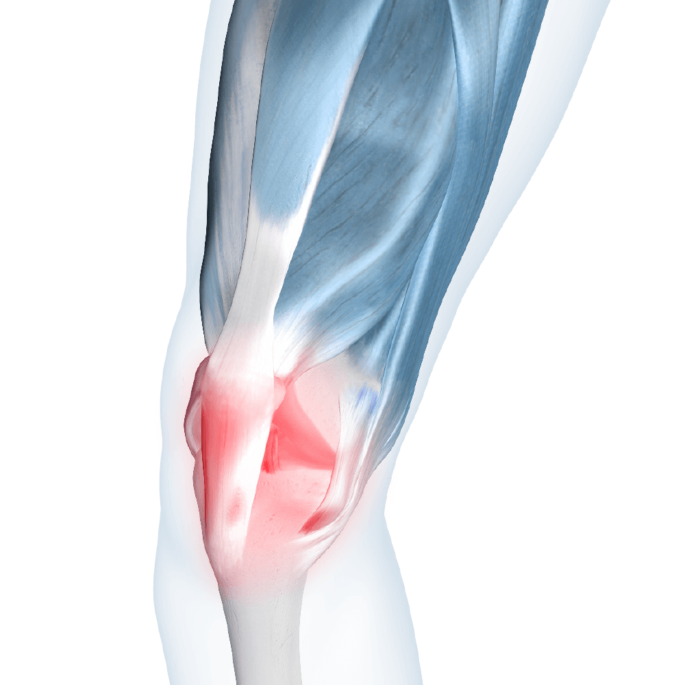 Patellar Tendonitis Image