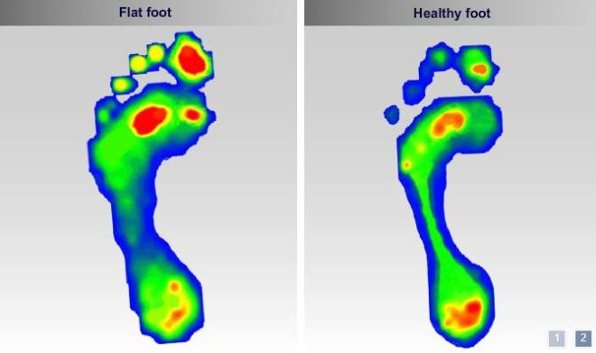 Heatmaps of a Flat Foot and Healthy Foot Scan