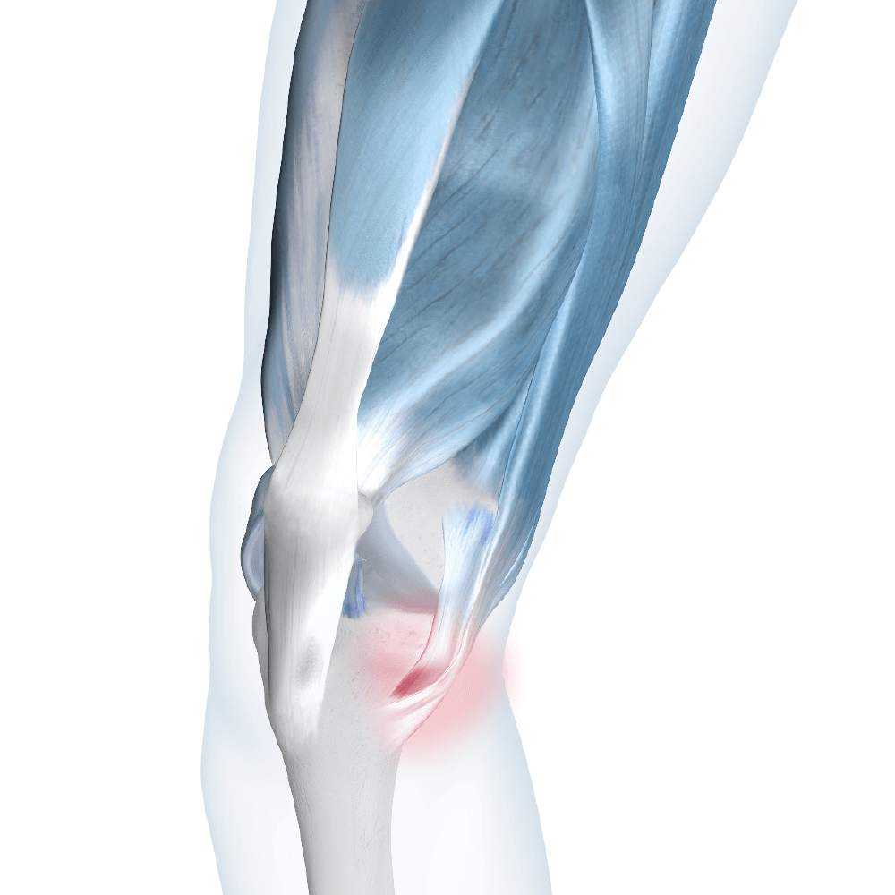 Pes Anserine Bursitis Image